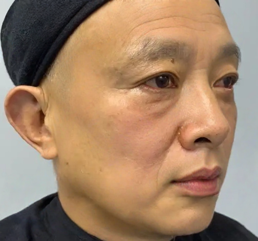 去眼袋手术