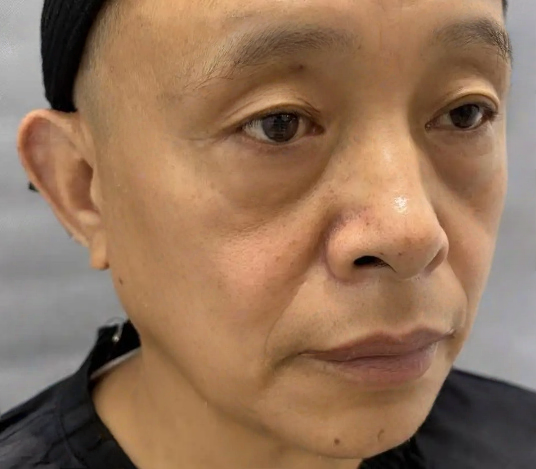 去眼袋手术