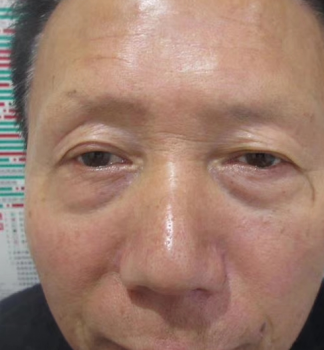 去眼袋手术
