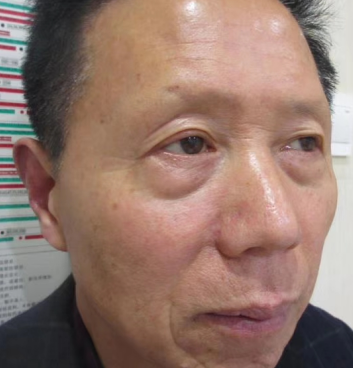 去眼袋手术