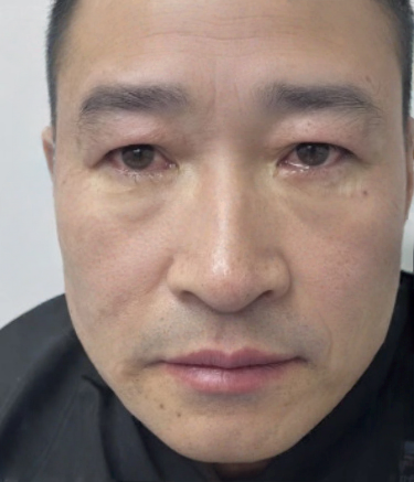 去眼袋手术