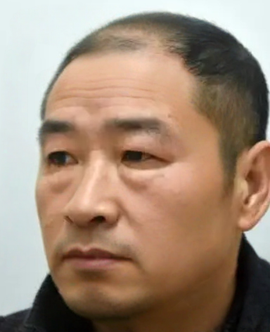 去眼袋手术