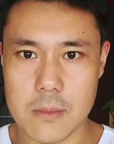 去眼袋手术