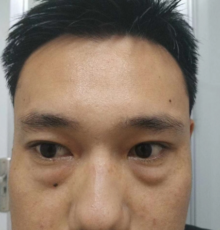 去眼袋手术