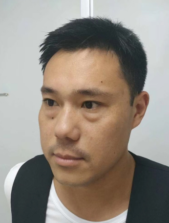 去眼袋手术