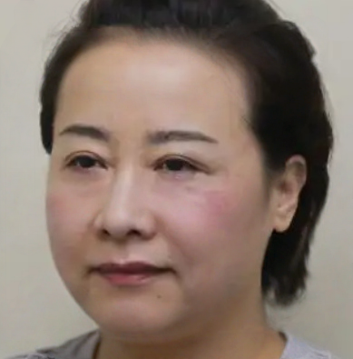 去眼袋手术