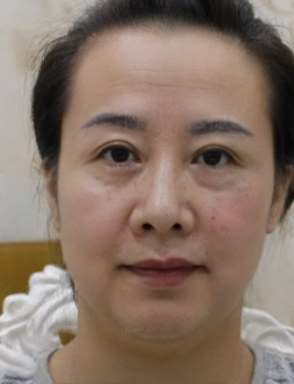 去眼袋手术