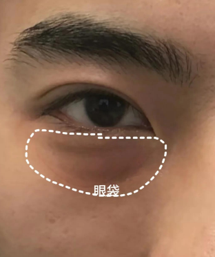 去眼袋手术