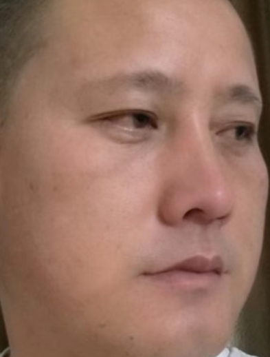 去眼袋手术