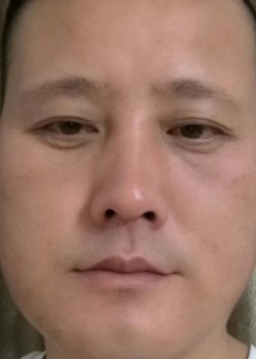 去眼袋手术