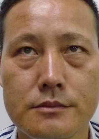 去眼袋手术