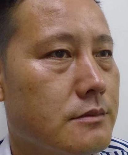 去眼袋手术