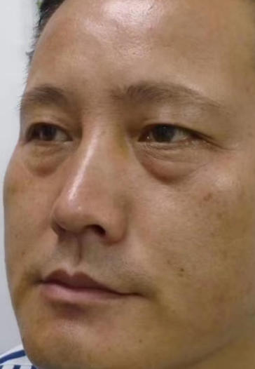 去眼袋手术
