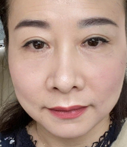 去眼袋手术