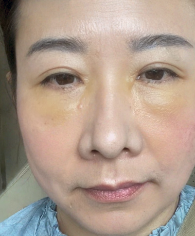 去眼袋手术