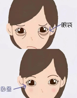 去眼袋手术