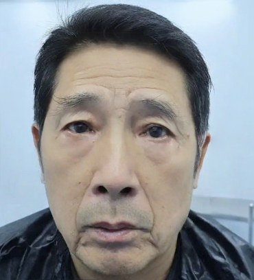 去眼袋手术