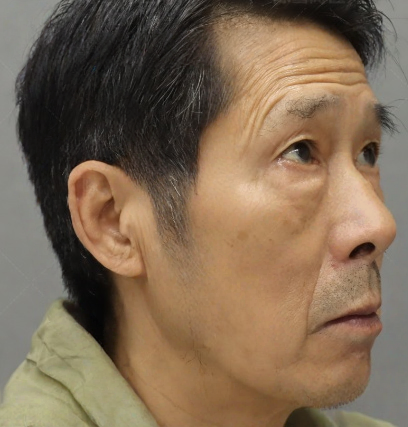 去眼袋手术
