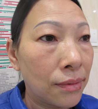 去眼袋手术