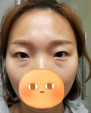 去眼袋手术