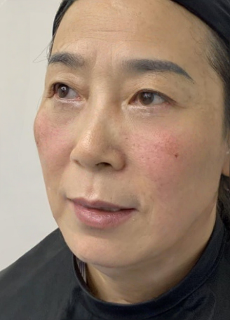 去眼袋手术