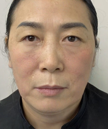 去眼袋手术
