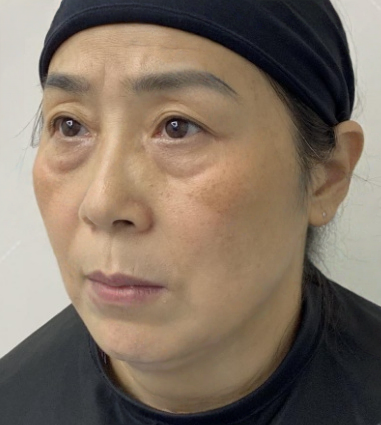 去眼袋手术