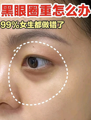 去眼袋手术
