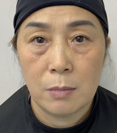 去眼袋手术