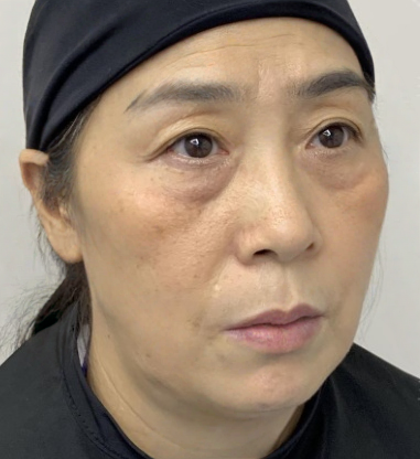 去眼袋手术