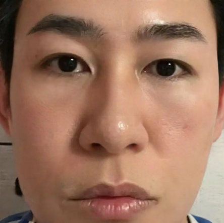 去眼袋手术