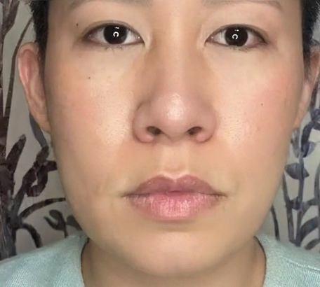 去眼袋手术