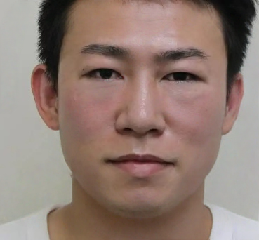 去眼袋手术