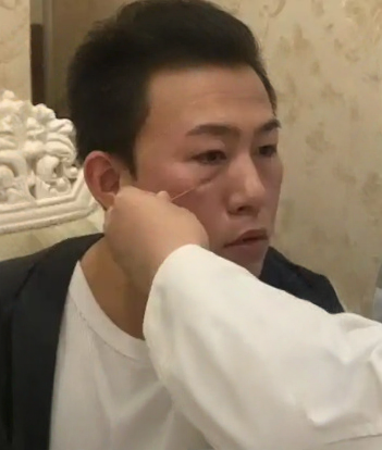 去眼袋手术