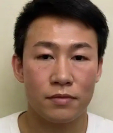 去眼袋手术