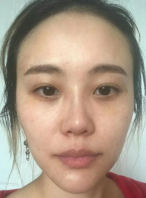 去眼袋手术
