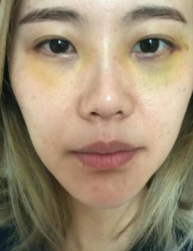 去眼袋手术