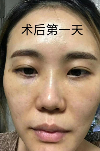 去眼袋手术