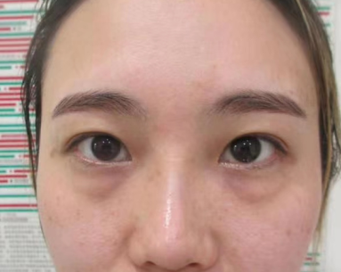 去眼袋手术