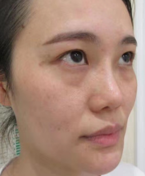 去眼袋手术