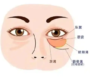 去眼袋手术