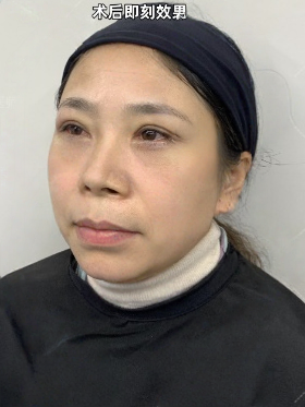 去眼袋手术