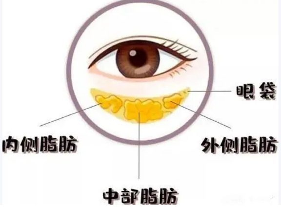 去眼袋手术