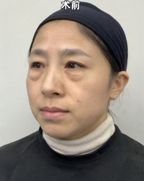 去眼袋手术