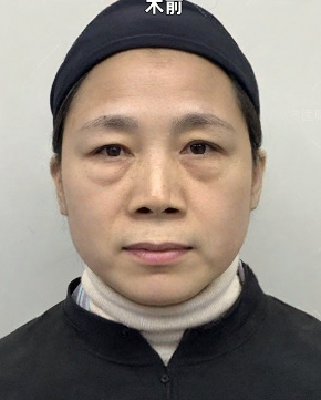 去眼袋手术