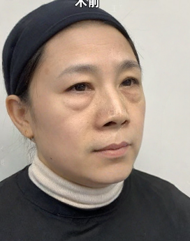 去眼袋手术