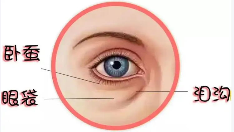 去眼袋手术