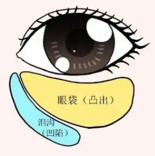 眼袋