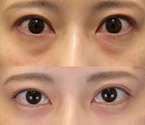 去眼袋手术