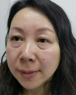 去眼袋手术
